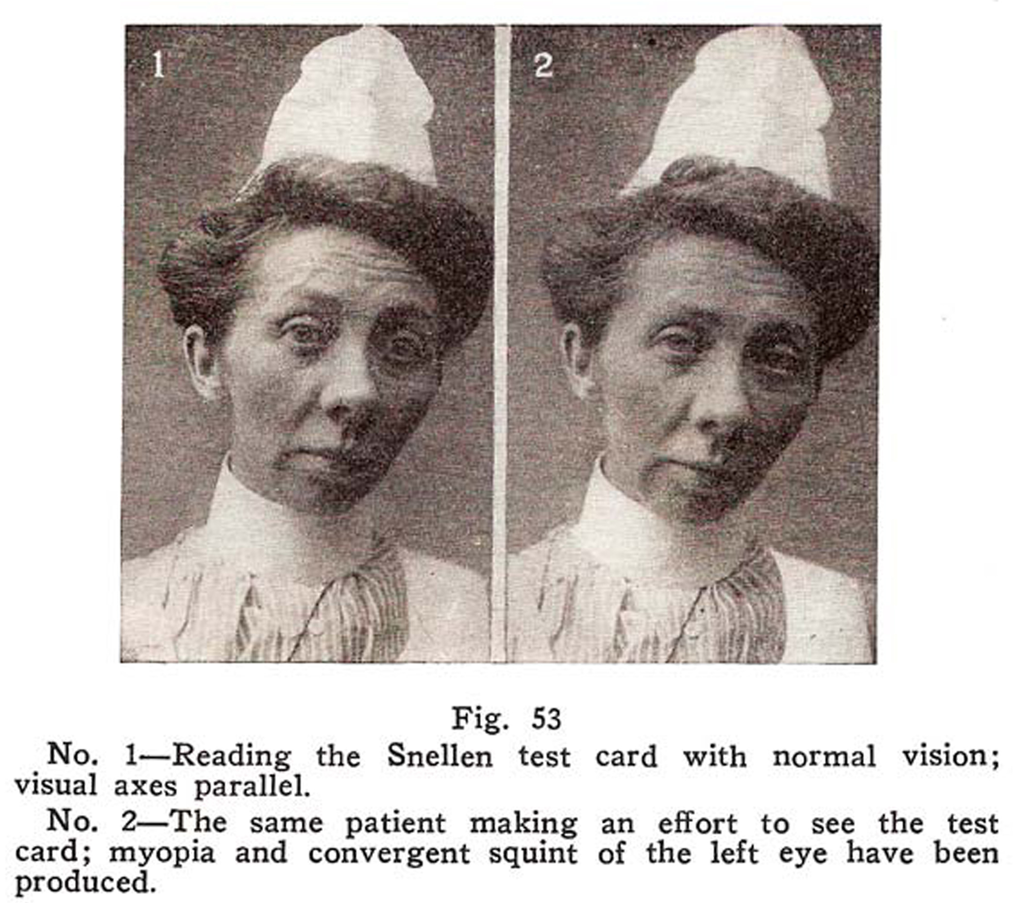 'Squint'; Strabismus - Crossed, Wandering Eyes Cured by Relaxation...